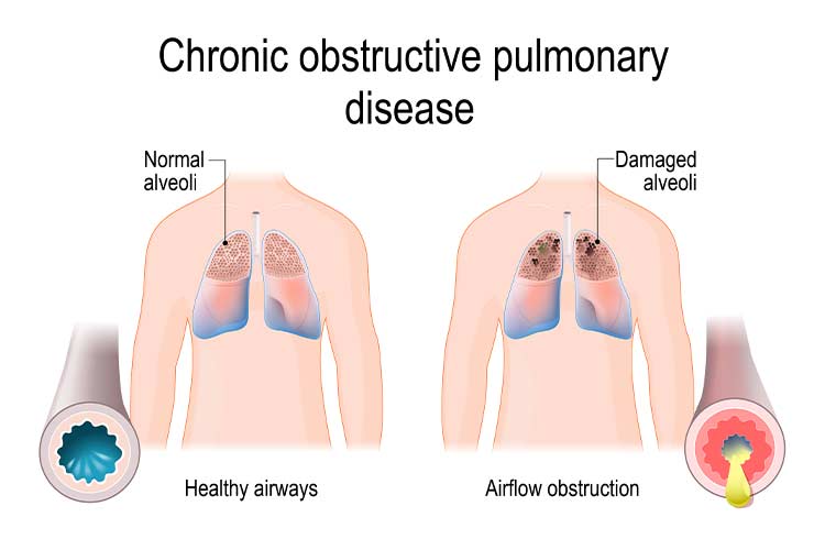 The Difference Between COPD and Emphysema