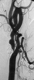 Carotid Artery