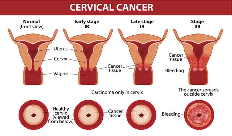 Cervical Cancer