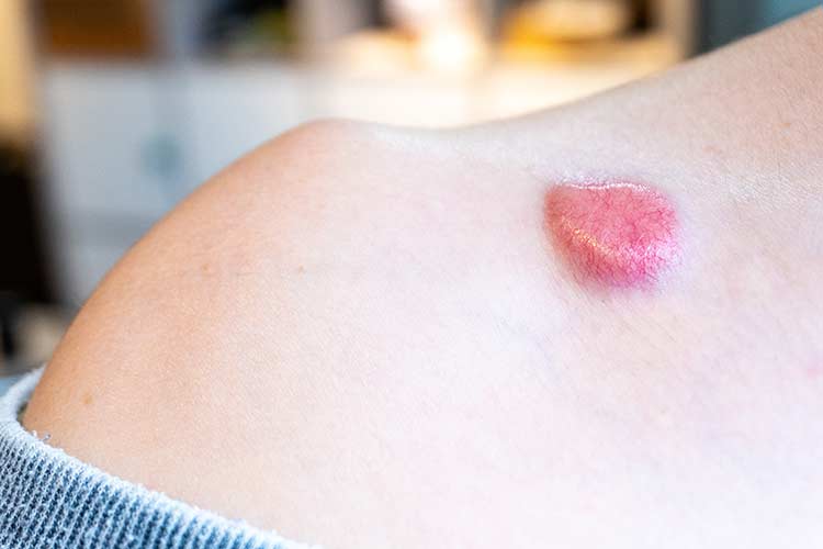 Nonmelanoma Skin Cancer