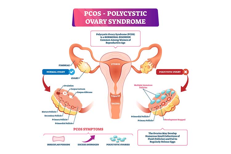 PCOS