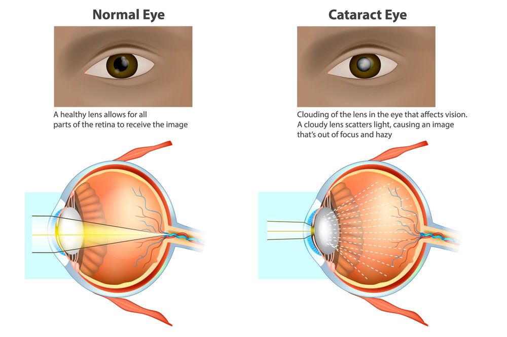 Eye illustration