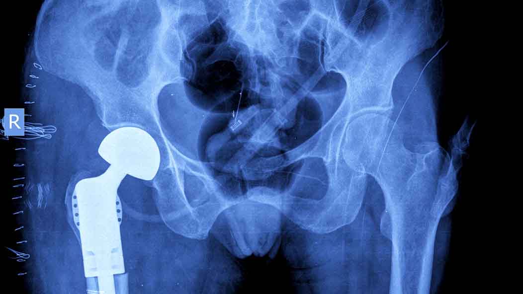 Hip Replacement